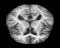 Alzheimer's Detection