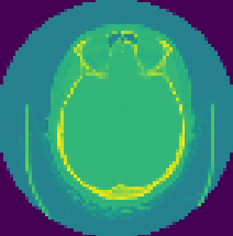 Intracranial Hemorrhage Detection